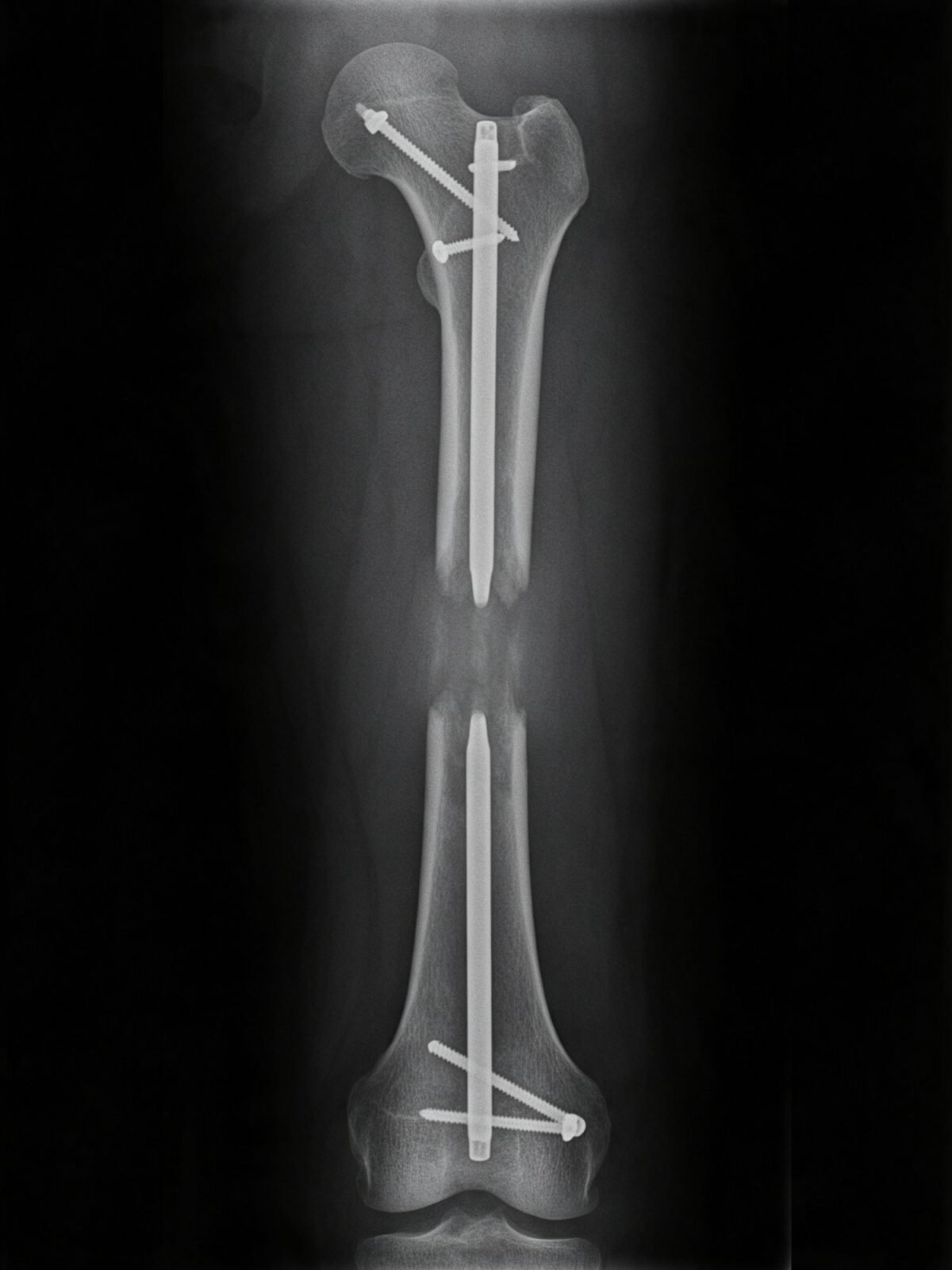 Illustrative render of a femur X-ray after lengthening with an intramedullary nail