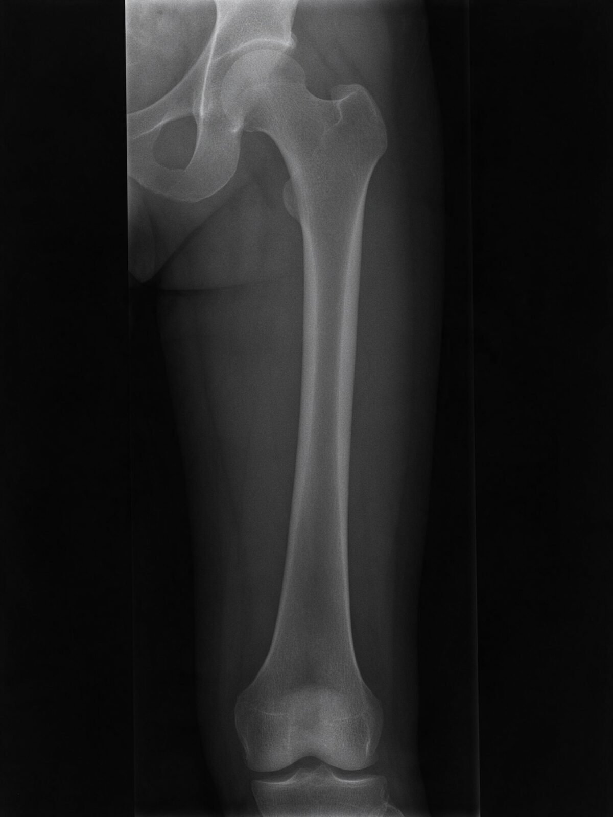 Illustrative render of a femur X-ray before surgery